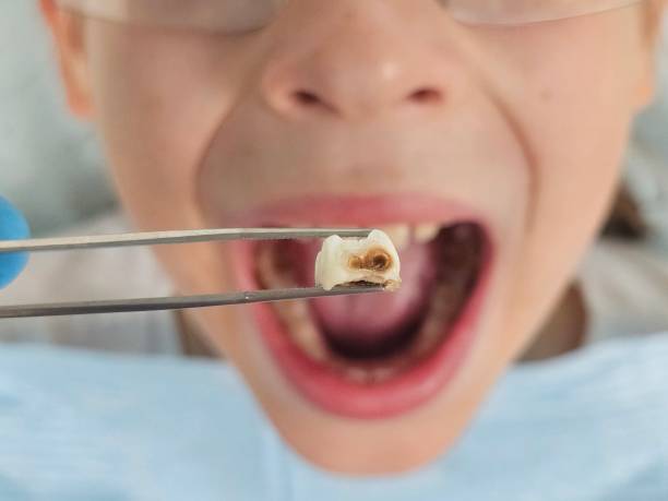 Best Emergency Tooth Extraction in Saranac, MI